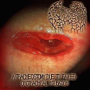 A Tracheostomy Due to Failed Orotracheal Intubation